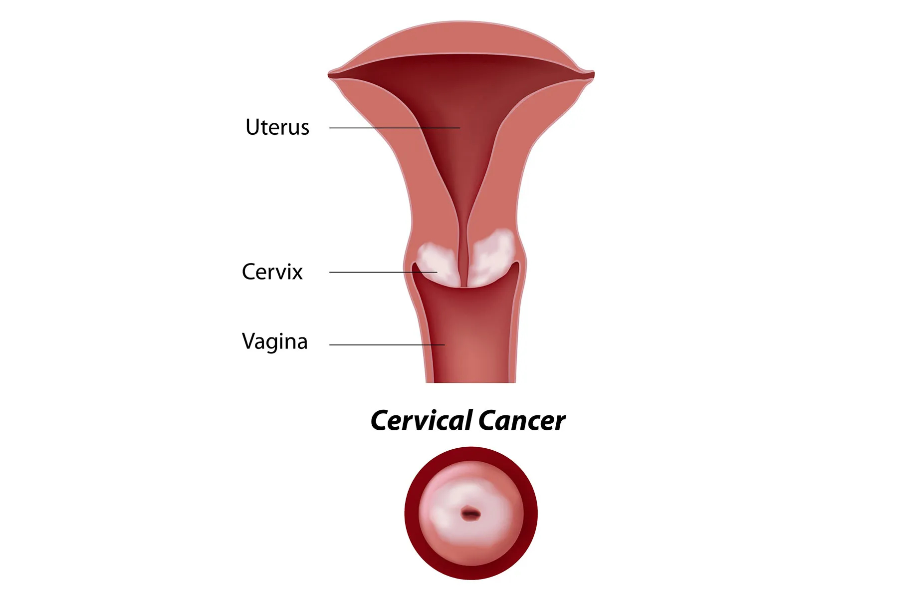 Cervical Cancer Symptoms Causes And Treatment